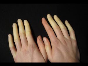 Witte vingers door Raynaud
